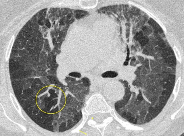 Hypersensitivity pneumonitis with head cheese sign