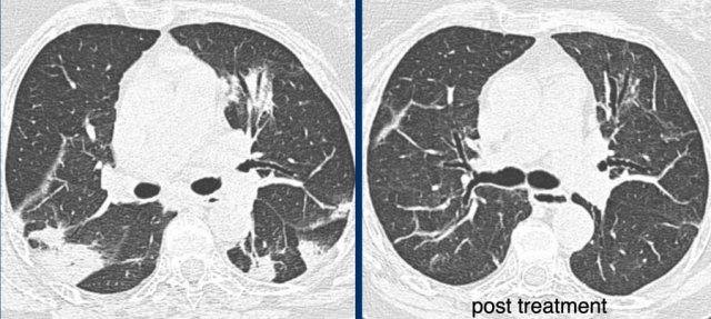 Organizing pneumonia. LEFT typical peripheral and central peribronchiolar consolidations with central airway dilatation. RIGHT post treatment