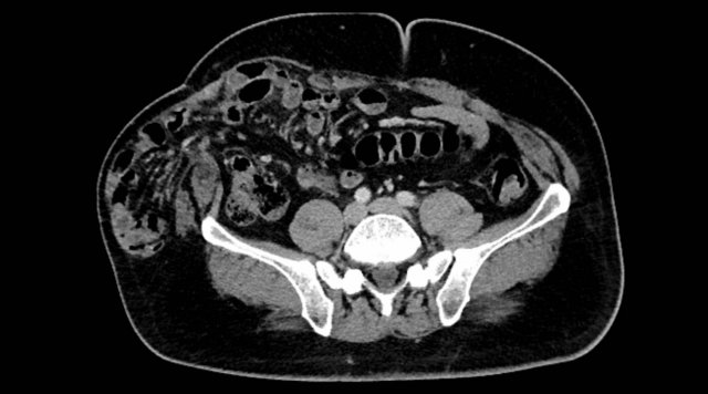 Abdominal wall hernias