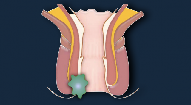 Anal cancer staging