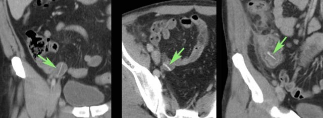 Hyperdense bones in three asymptomatic patients