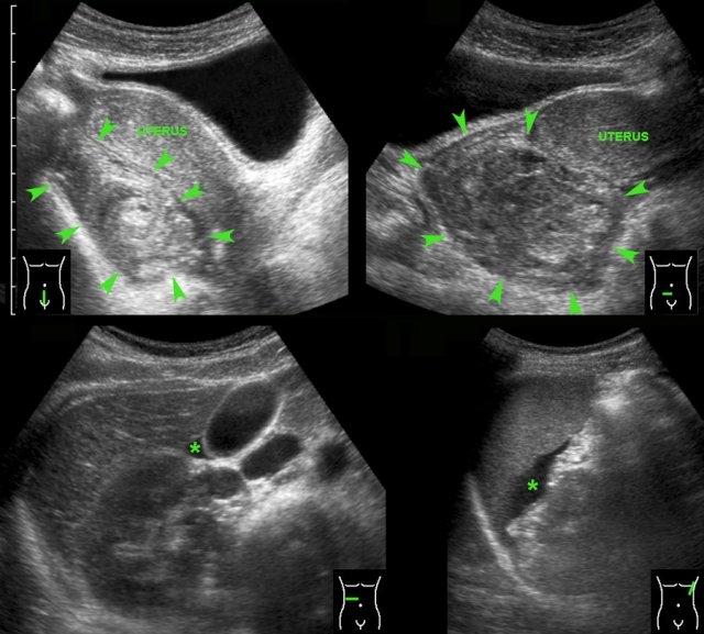 Unexpected ectopic pregnancy