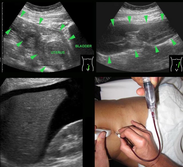 Unexpected ectopic pregnancy.