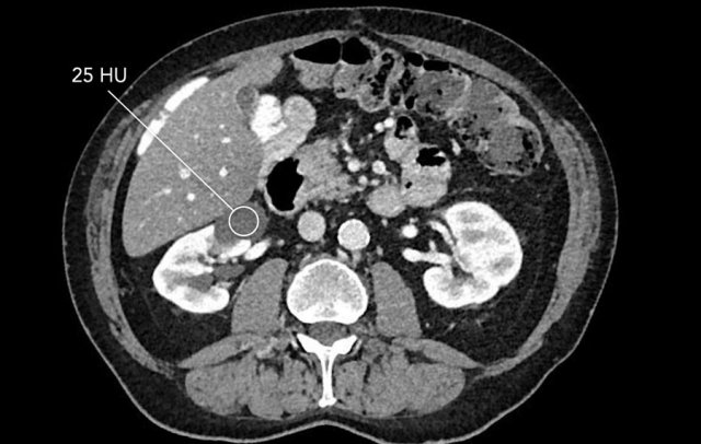 Portal venous scan of a cyst with mean HU of 25 in the anterior right Kidney. According to the new Bosniak criteria all cyst with HU <30 are likely benign and can be classified as Bosniak II without any additional imaging