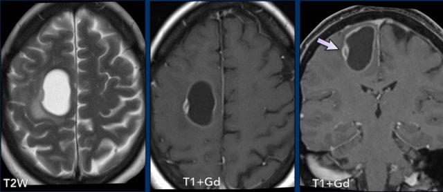 Glioblastoma