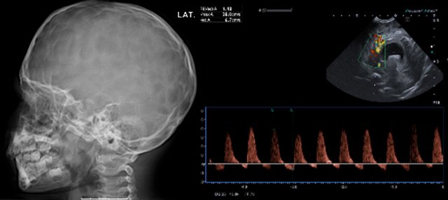 Raised intracranial pressure