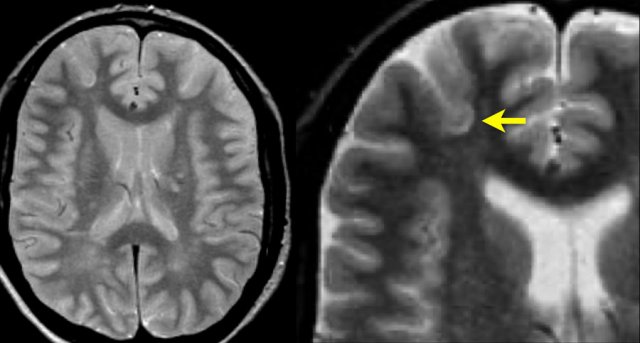 Juxtacortical MS lesion located in the U-fiber.