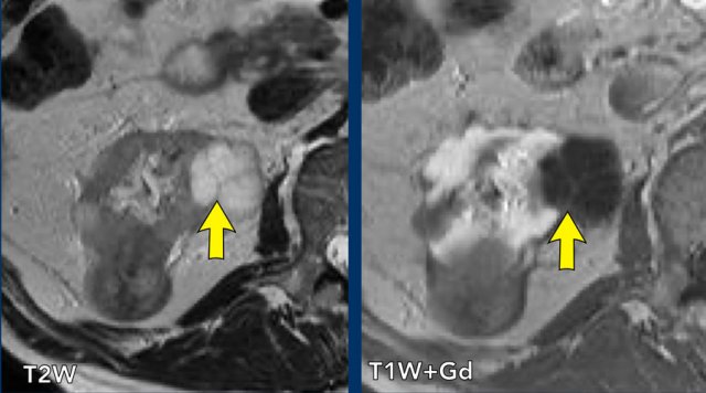 Bosniak II cyst