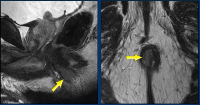 Anal tumor in the middle and lower third of the anal canal before treatment.