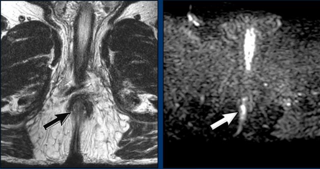 Residual tumor 6 weeks post chemoradiation.