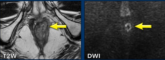 Local recurrence 2 years after completion of CRT