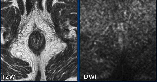 No residual tumor 6 months post chemoradiation.