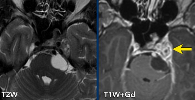 Trigeminal schwannoma