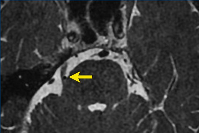 Neurovascular compression at the root entry zone