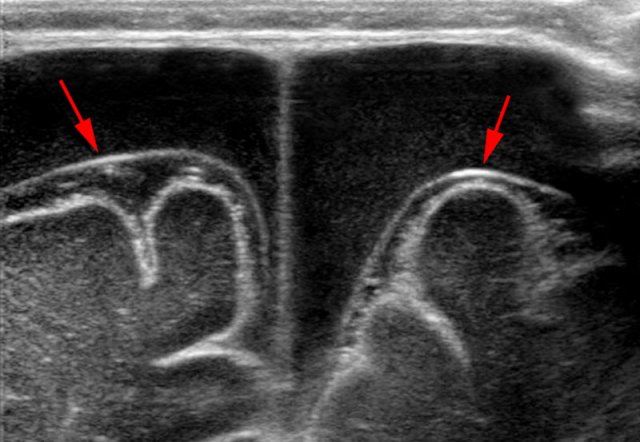 Bilateral hypoechoic subdural fluid collections that outline the arachnoid membrane very well (arrows). The cloudy aspect of the fluid suggests it is hemorrhagic. The subdural hematomas barely show any vessels in contrast with the abundant subarachnoid vessels.