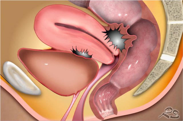 Deep Infiltrating Endometriosis (DIE)