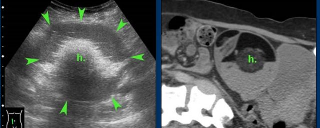 Torsion of large dermoid cyst, missed by gynaecological TVUS. (h. = hairball)