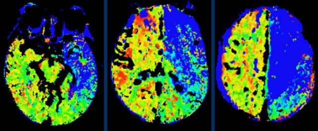 Poor perfusion in the anterior and middle cerebral artery territory (all penumbra, no infarct core on CBV images (not shown)