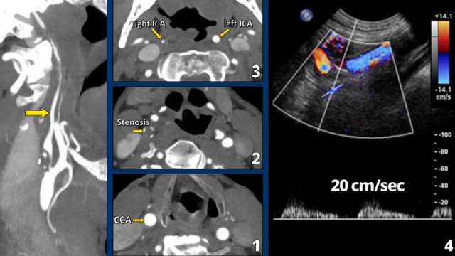 Click on image for an enlarged view. Small distal caliber of the distal ICA and a drop in systolic peak velocity.