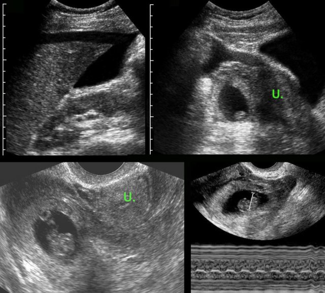 Ectopic pregnancy with living fetus.