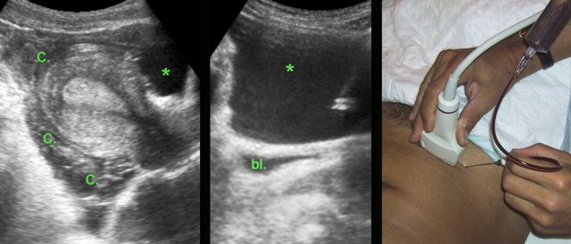 Luteal body bleeding mimicking ectopic pregnancy