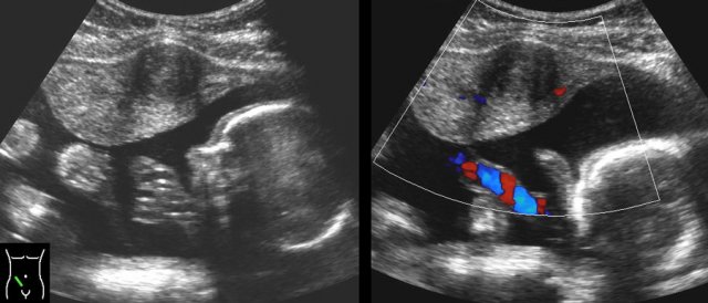 ischemic myoma in pregnancy