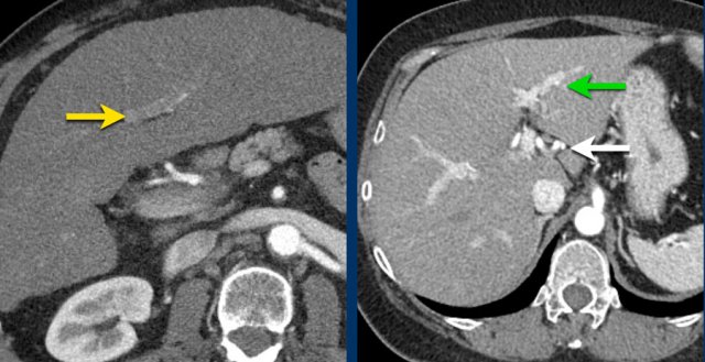 Early aterial phase (left).  Late arterial phase (right).