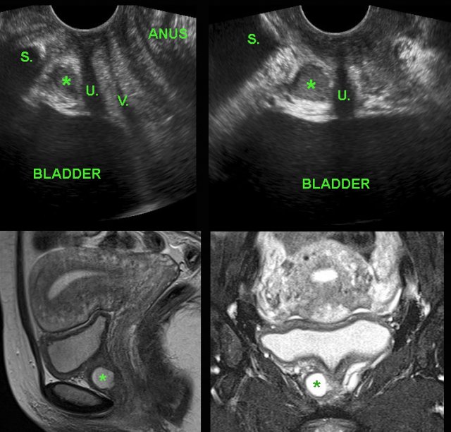 Urethral diverticulum demonstrated by TVUS.