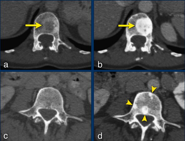 The sclerotic bone lesions in b and d are not new metastases but an osteoblastic reaction. Courtesy Els van Persijn van Meerten.