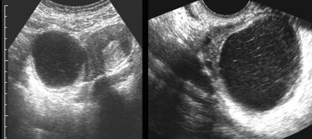 Persistent haemorrhagic cyst.