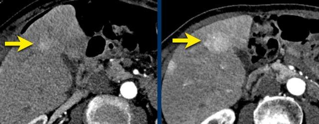 LEFT: Hyperenhancing observation detected in segment 5.  RIGHT: follow up 3 months later shows growth.