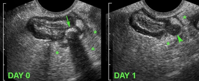 Uncomplicated course of sigmoid diverticulitis documented by TVUS.