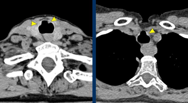 Tracheobronchopathia osteochondroplastica