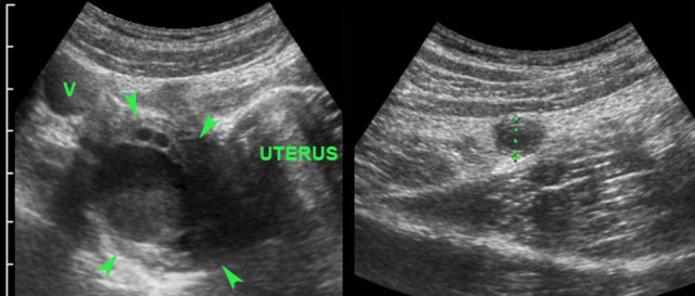 Acute appendicitis and right ovarian cyst. (v= iliac vein)