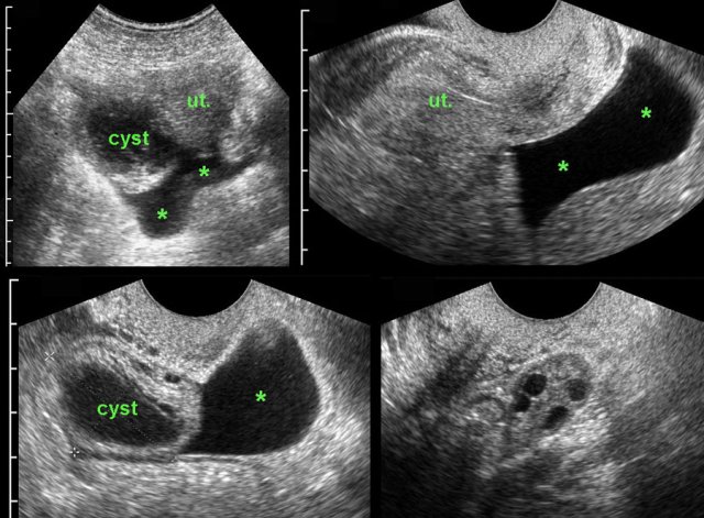 Ruptured follicle. (ut = uterus)