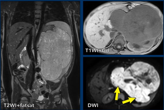 Nephroblastoma in a five-year-old boy.