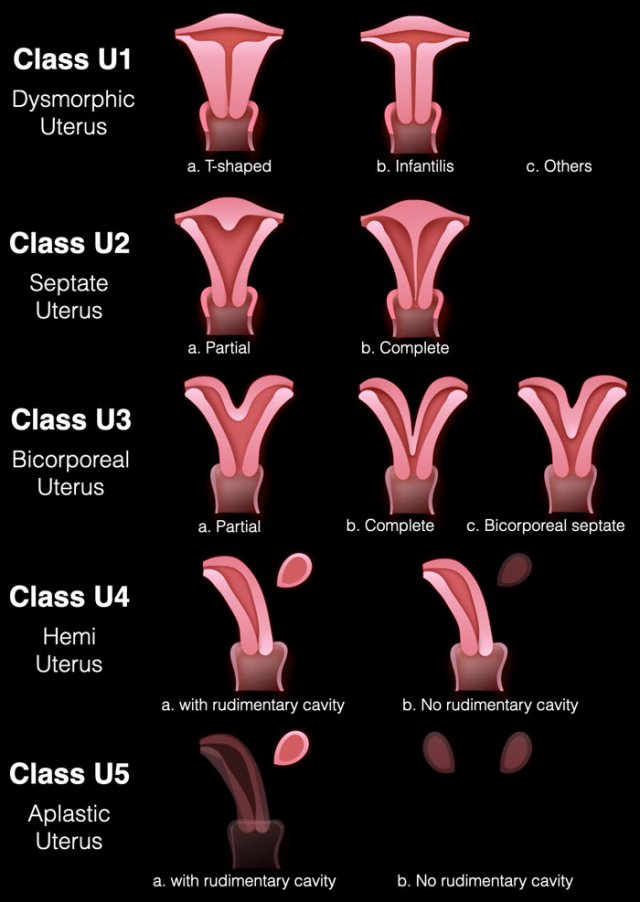 European classification system ESHRE/ESGE. Click for larger view.