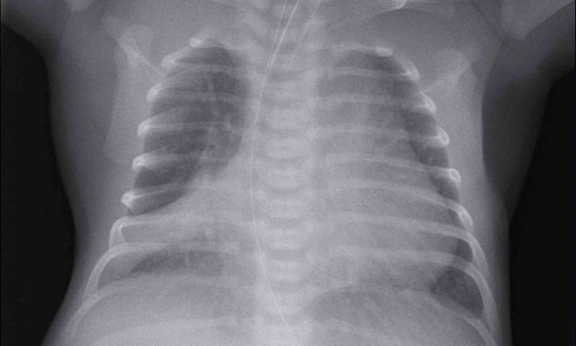 Atelectasis of the right middle lobe