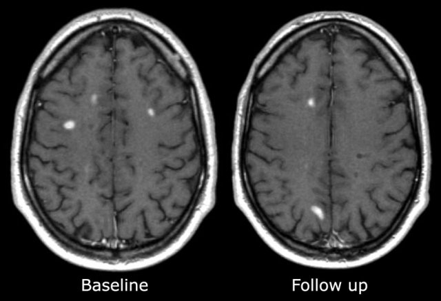 T1WI: enhancing lesions on baseline scan and new enhancing lesions on follow up 3 months later..