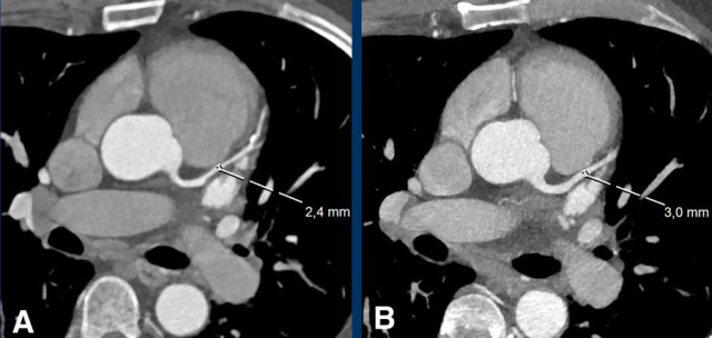 Example of a CTA scan performed on the same scanner in the same patient without (A) and with (B) administration of nitroglycerin, showing the increased diameter of the LAD. Due to the vasodilatory effect nitroglycerine increases the number of assessable (>1.5 mm diameter) segments.