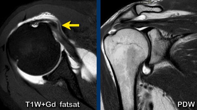 Dislocation of long head biceps tendon with a partial thickness tear of the subscapularis tendon and a full thickness tear of the supraspinatus tendon