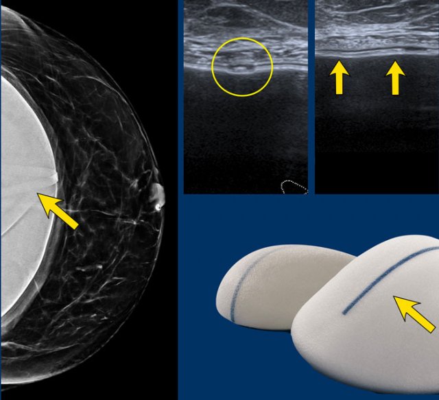 Band-like marking on a breast implant