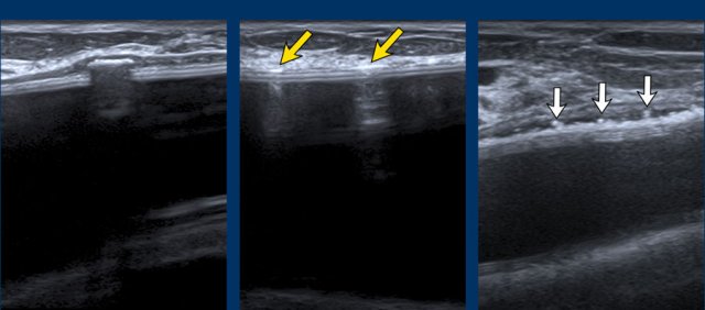 Capsular calcifications