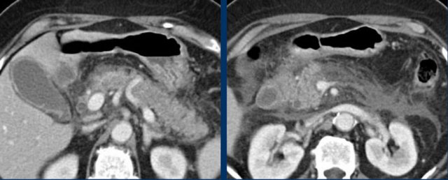 Acute pancreatitis simulating acute cholecystitis