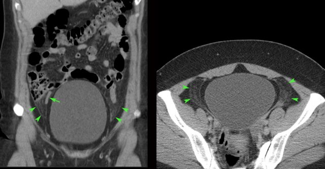 PID due to Chlamydia infection