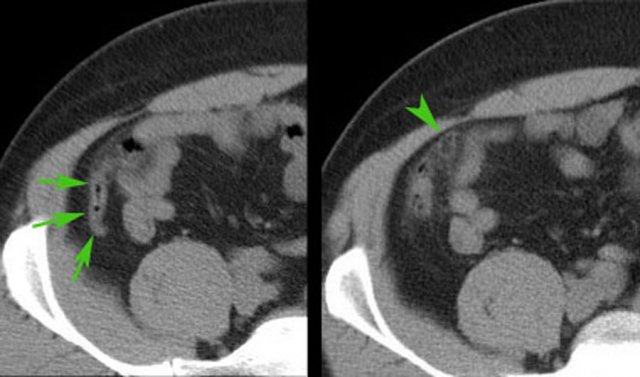 Epiploic appendagitis