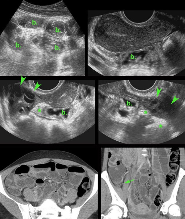 Paralytic ileus in gonorrhoeic PID.