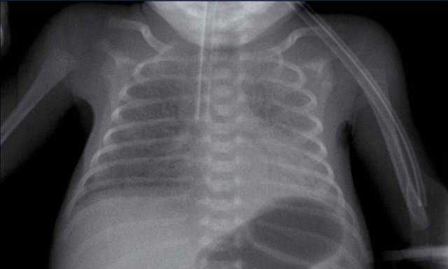 Respiratory distress syndrome