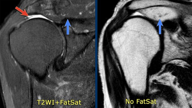 Irregular full thickness tear.