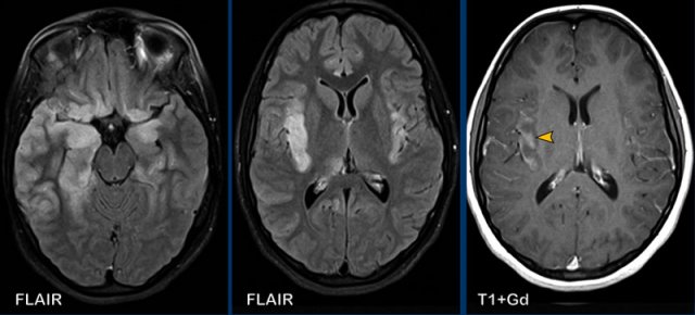 Herpes encephalitis